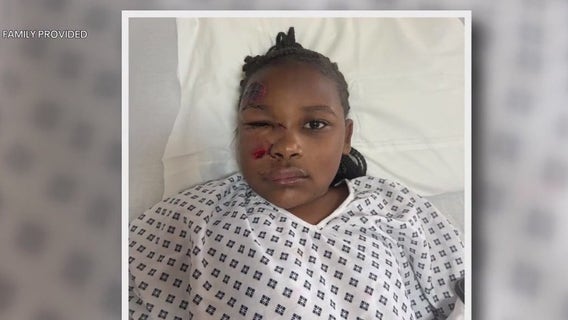 Girl, 11, victim of hit-and-run speaks out: 'I can't believe somebody would just leave me on the street'