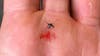 NJ resident infected with malaria, state officials investigate