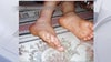 Hand-Foot-and-Mouth Disease on the rise: How parents can protect their children