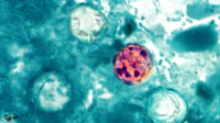 Pennsylvania added to cyclosporiasis outbreak list with at least 2 dozen cases
