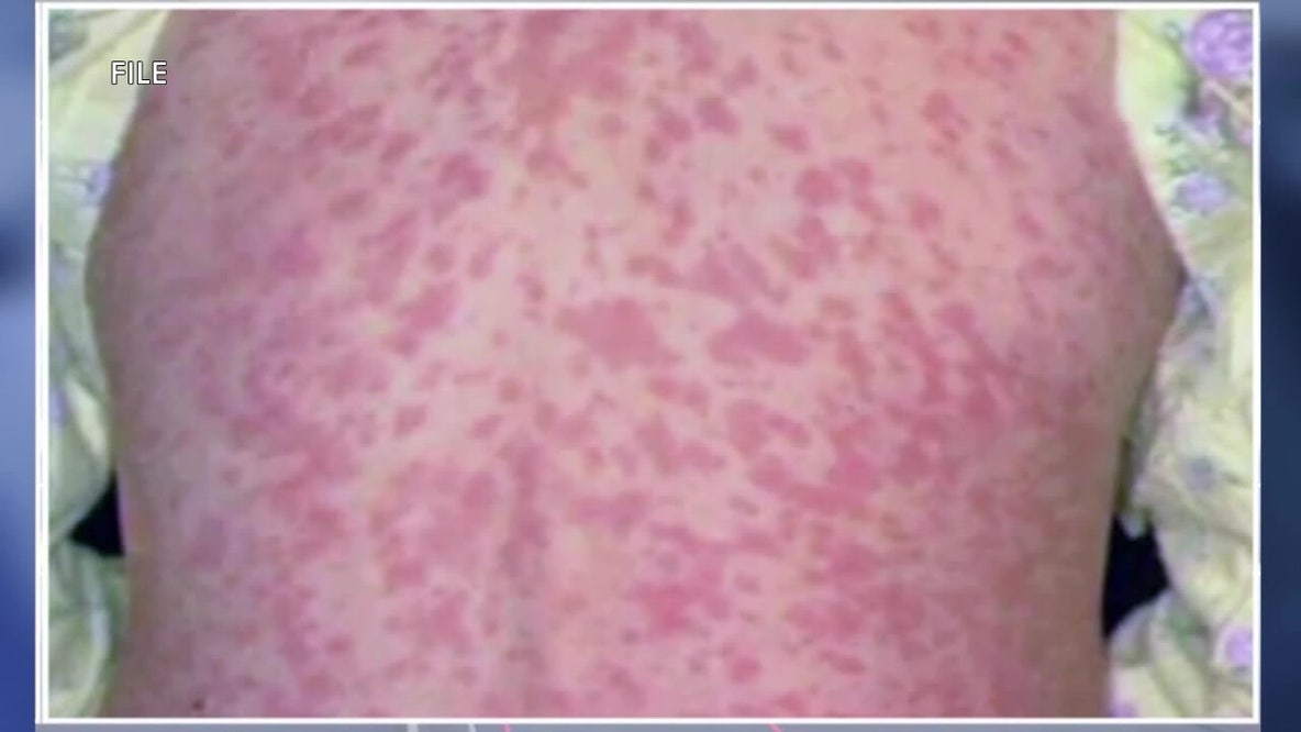 Pennsylvania confirms 4 measles deaths; outbreak grows to 693 cases in 38 counties