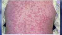 Pennsylvania confirms 4 measles deaths; outbreak grows to 693 cases in 38 counties