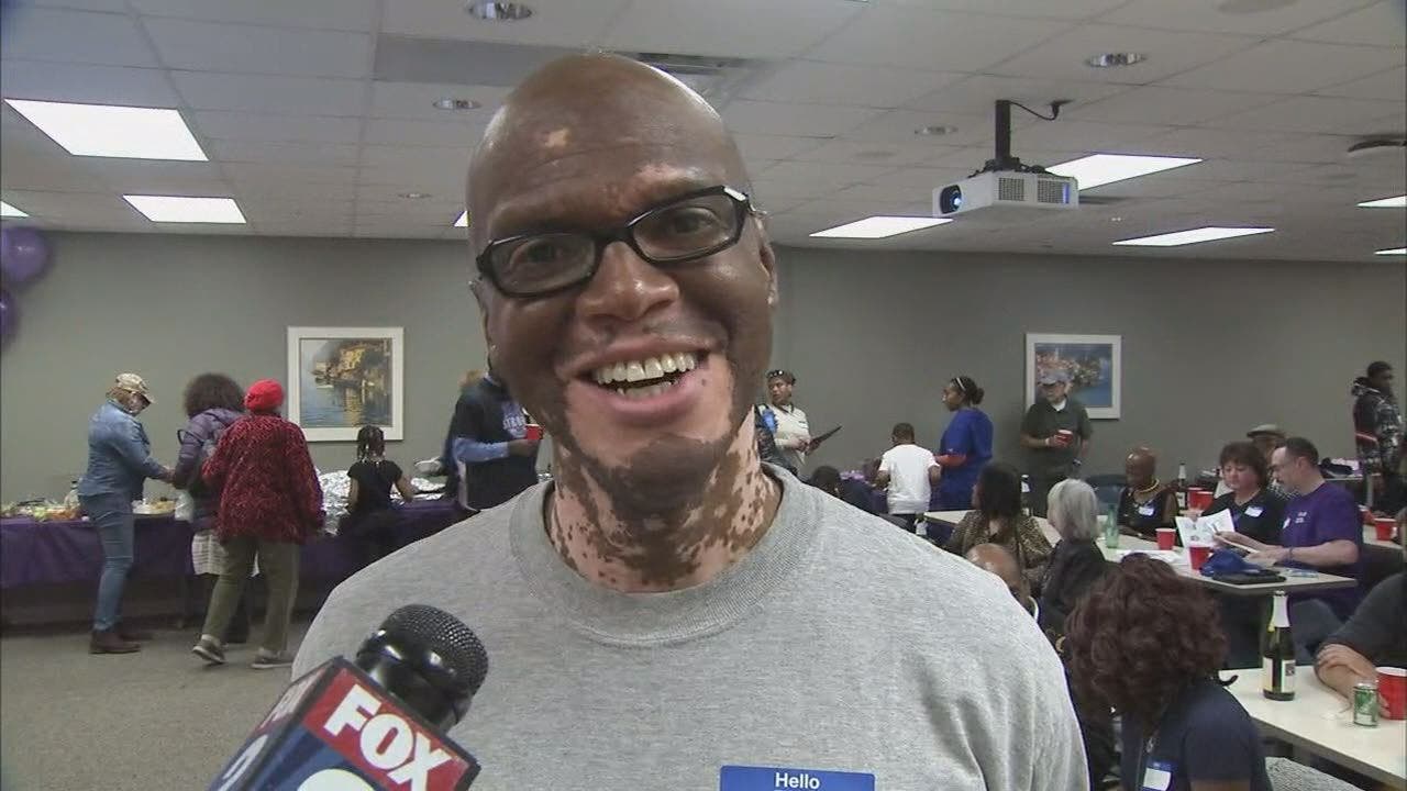 Lee Thomas's vitiligo support group celebrates 10 years
