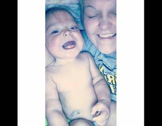 Get Wallpaper Baby With Genetic Syndrome Smiling After Tongue Reduction Surgery For Android Free