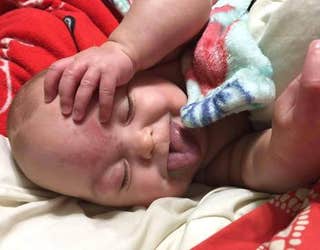 baby with genetic syndrome smiling after tongue reduction surgery