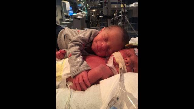 Newborn twins share final hug before CDH surgery