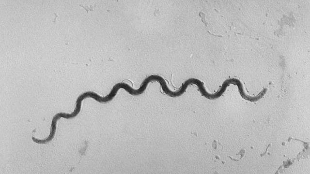 Rates of syphilis spike in Michigan, including 42 diagnoses in infants as STDs surge around U.S.