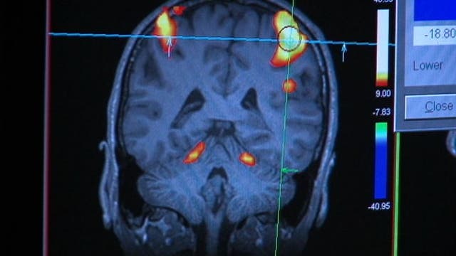 Early Alzheimer's Disease detection starts with MRI