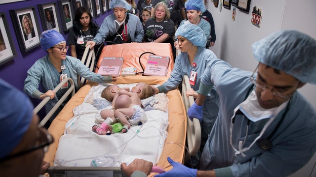 Conjoined identical twins successfully separated at Texas Children's Hospital