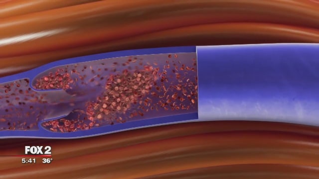 Blood clot risks and what to look for