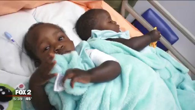 Conjoined twins now taking separate strides