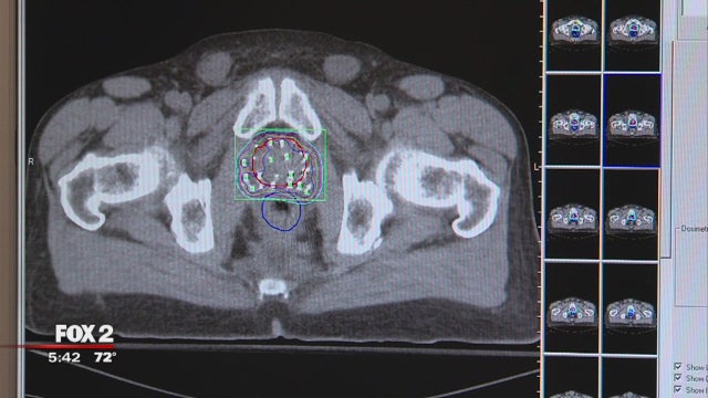 Height may affect risk of prostate cancer, new research says