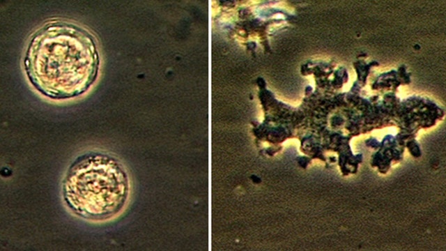 Woman gets brain-eating amoeba after using tap water in Neti Pot, doctors say