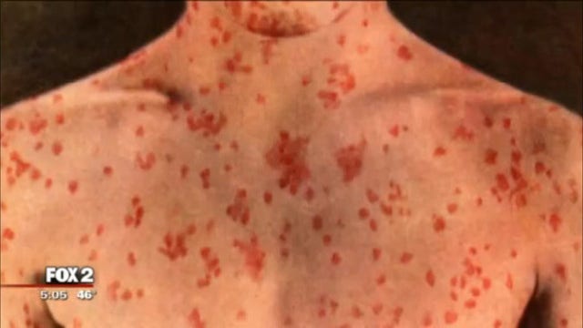 Michigan measles outbreak continues, 41 cases confirmed including first in Washtenaw