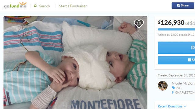 Surgeons in NYC separate conjoined twin boys