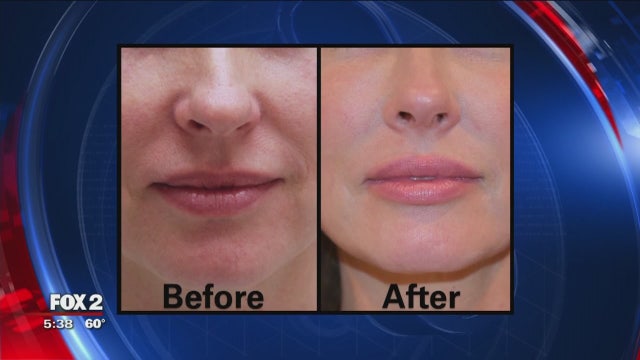 New statistics show that lip procedures are booming