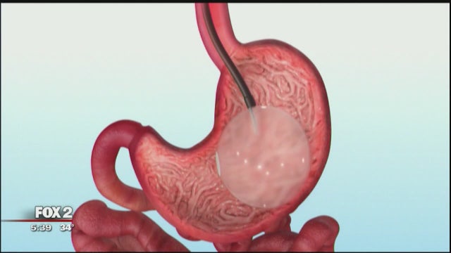 New weight loss procedure places balloon in your stomach