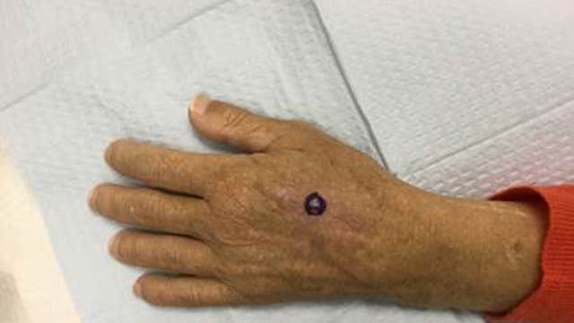 Organ transplants save lives, raise skin cancer risk