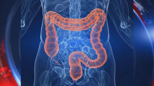 Cancer group says colon screening should start at 45, not 50