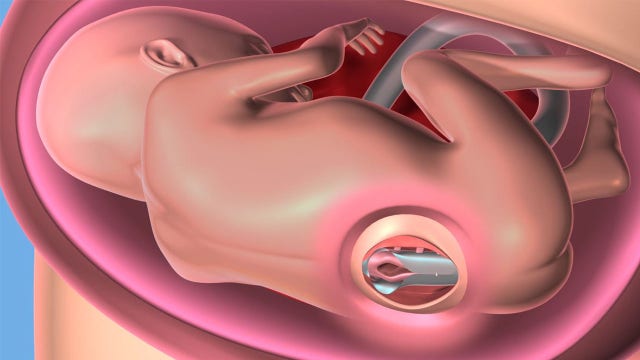 Cleveland Clinic performs its first in-utero surgery