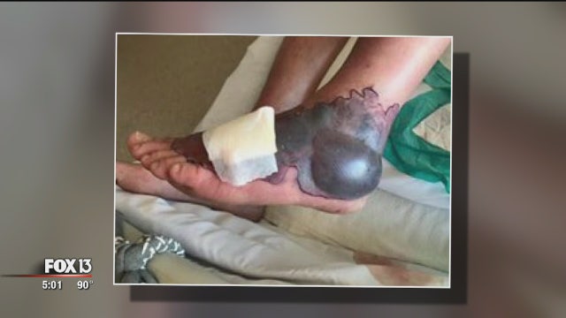 Ohio man nearly loses foot after contracting flesh-eating bacteria in Florida