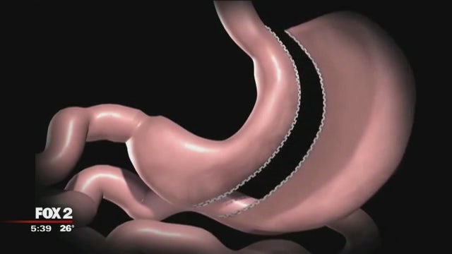 What you need to know about weight loss surgery