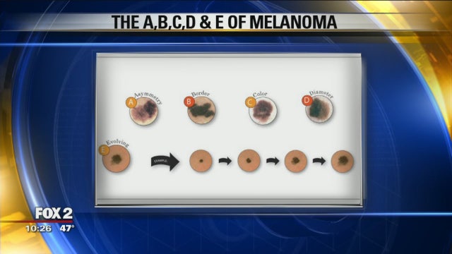 Melanoma Monday: Shining a light on skin cancer