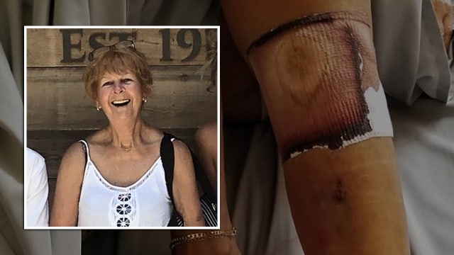 Family says Ellenton beachgoer died from necrotizing fasciitis