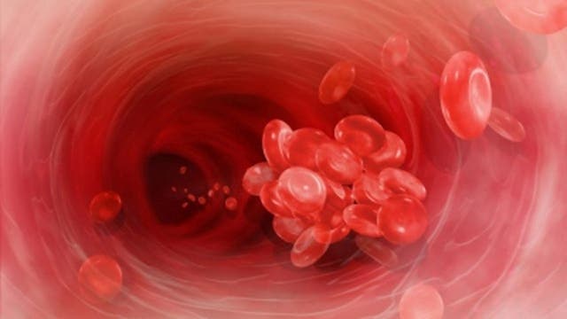 Blood clots in legs and how to prevent them