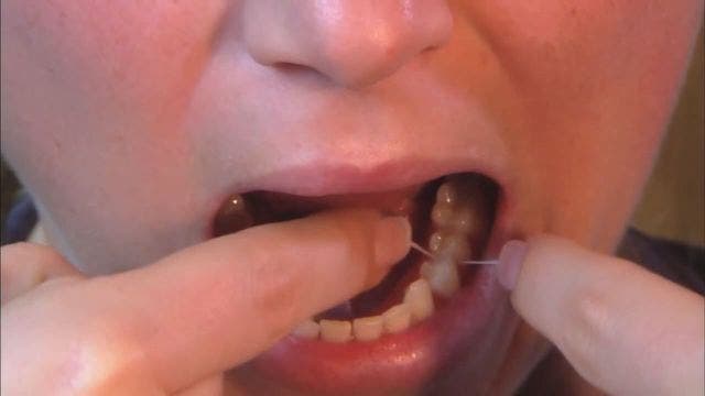 Little evidence of medical benefits of dental floss