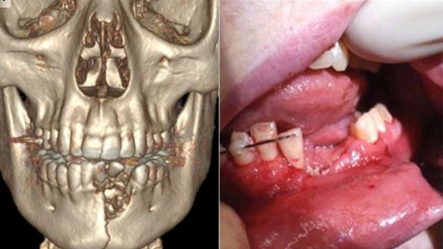 Vape pen explodes, shattering teenager's jaw and knocking out some teeth