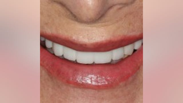 Local Dentist looking for Implant patients at reduced rates