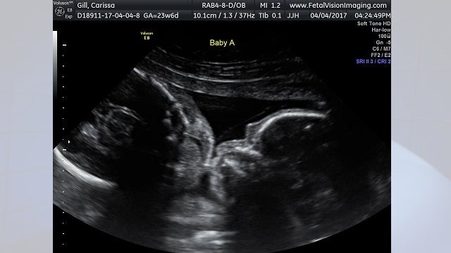 Croydon woman's ultrasound shows twin babies kissing in mother's womb