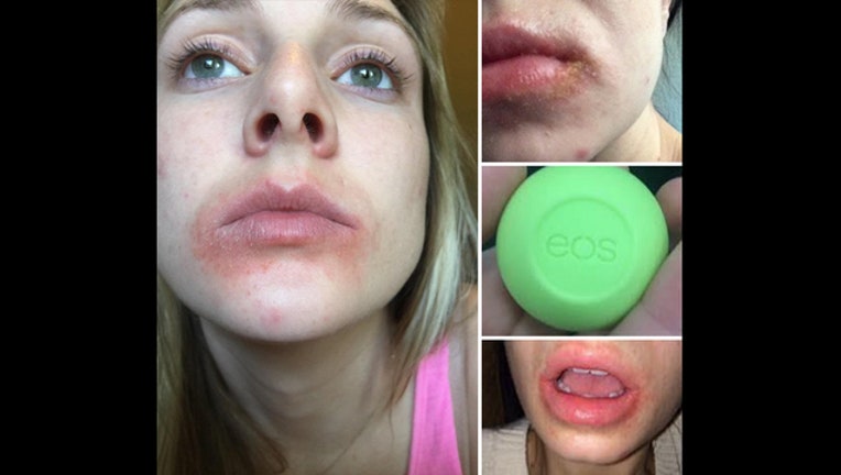Class-action lawsuit: EOS lip balm causes severe blisters, rashes