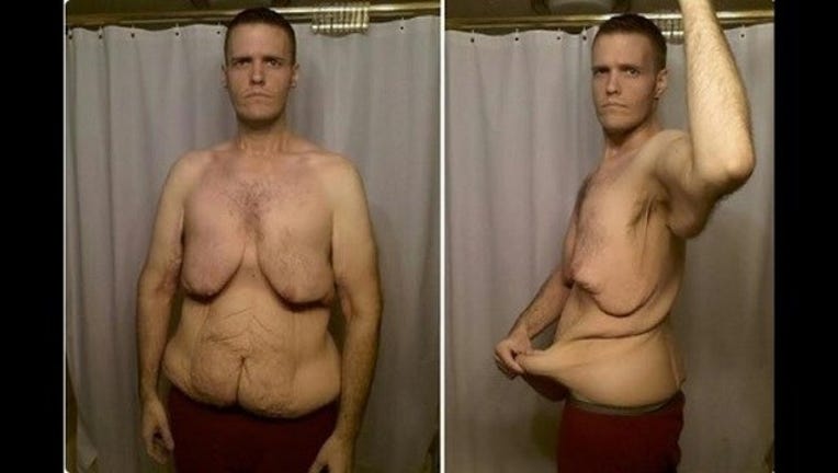 Man - Cellulite & Skinny Fat, Before and After Weight Loss