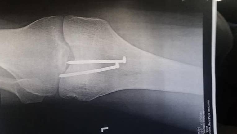 17fcf67d-nails into knee_1453832535116.jpg