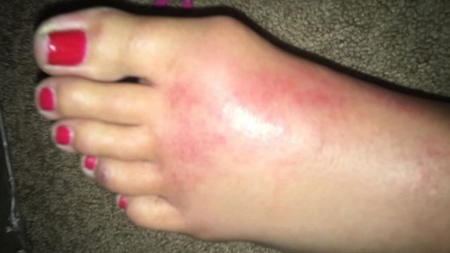 Flesh-eating bacteria ravages California woman's foot, exposing bone