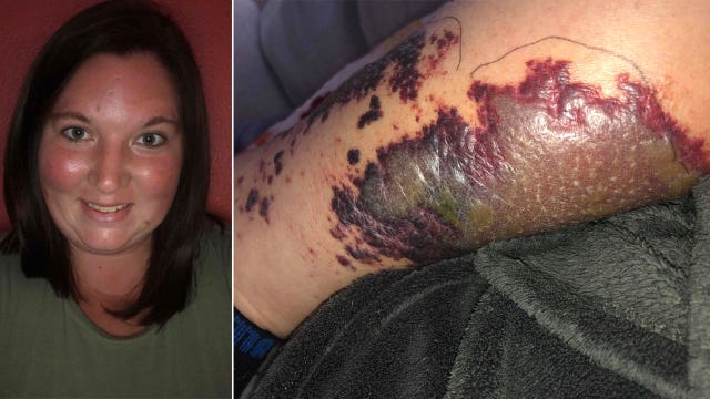 Woman nearly loses her leg to bacterial infection she says she contracted from hotel hot tub
