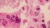 2 more measles cases detected in Michigan, Wayne and Washtenaw counties report