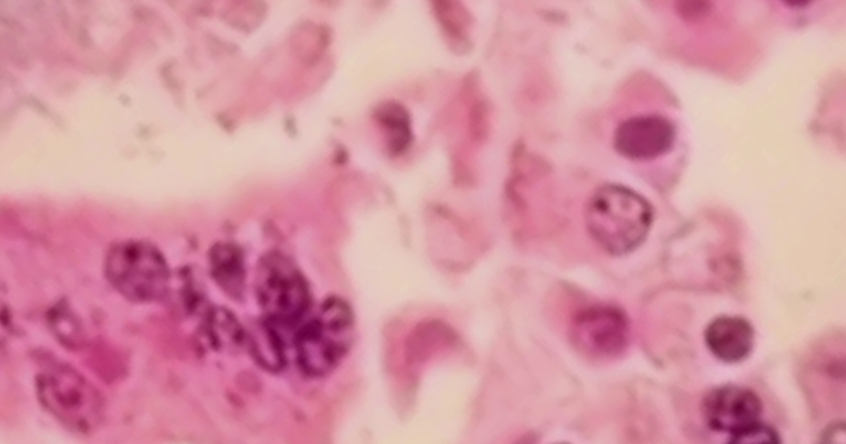 Measles outbreak in Michigan county as cases spread 'like wildfire'