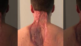 Dad’s skin cancer battle leaves him with massive chunk missing from neck, back