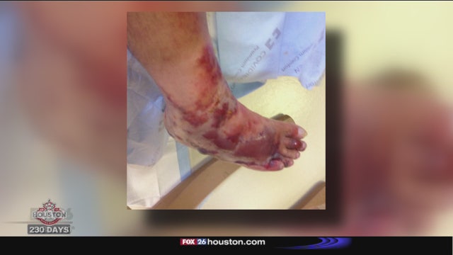 Man contracts flesh-eating bacteria in Galveston
