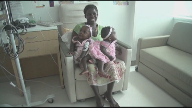 Conjoined twins from Uganda separated at Ohio hospital