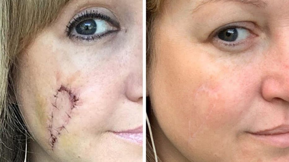 Natalie pictured before and after her scarring healed.