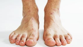 Michigan man’s toe used to replace thumb sawed-off in woodworking accident