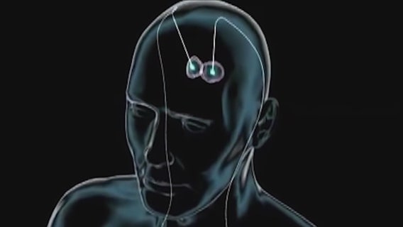 After medication and brain surgery, it took burying electrodes in a woman's brain to stop her seizures