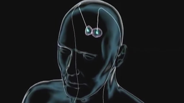 After medication and brain surgery, it took burying electrodes in a woman's brain to stop her seizures