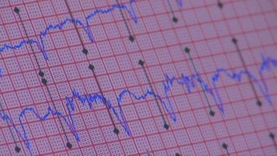 ERs seeing less heart attack, stroke patients during COVID-19
