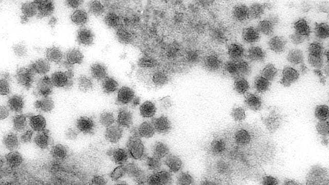 Patient with coroanvirus developed rare nervous disease, Henry Ford doctors say