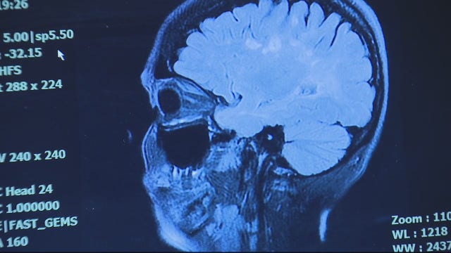 MIND in Farmington Hills helps provide hope to patients living with multiple sclerosis